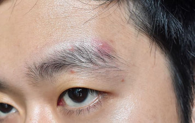 How to get rid of eyebrow acne