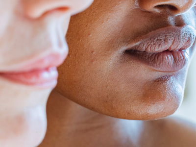 What is skin purging?