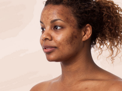 How to get rid of acne marks