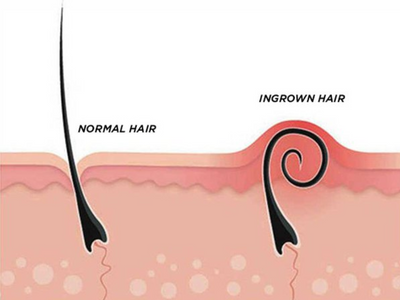 Dealing with ingrown hair