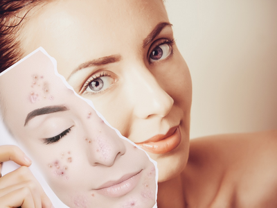 6 Skincare Mistakes That Can Make Acne Worse