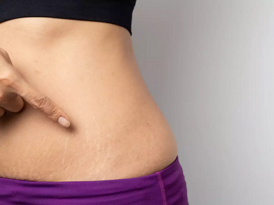6 Natural Ways To Avoid Stretch Marks