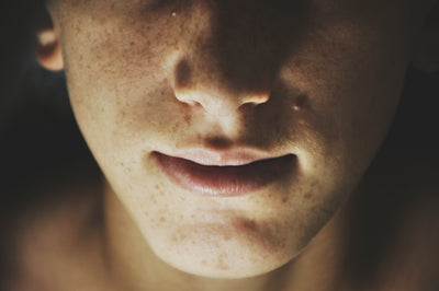 Everything you need to know about hyperpigmentation