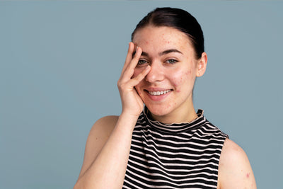 Dealing with melasma
